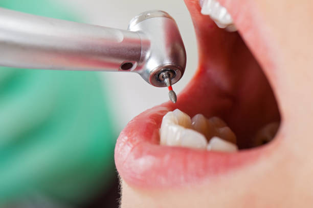 Best Emergency Wisdom Teeth Removal in Lake Nacimiento, CA